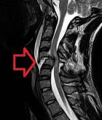 Spinal-Cord-Injury-Picture-1