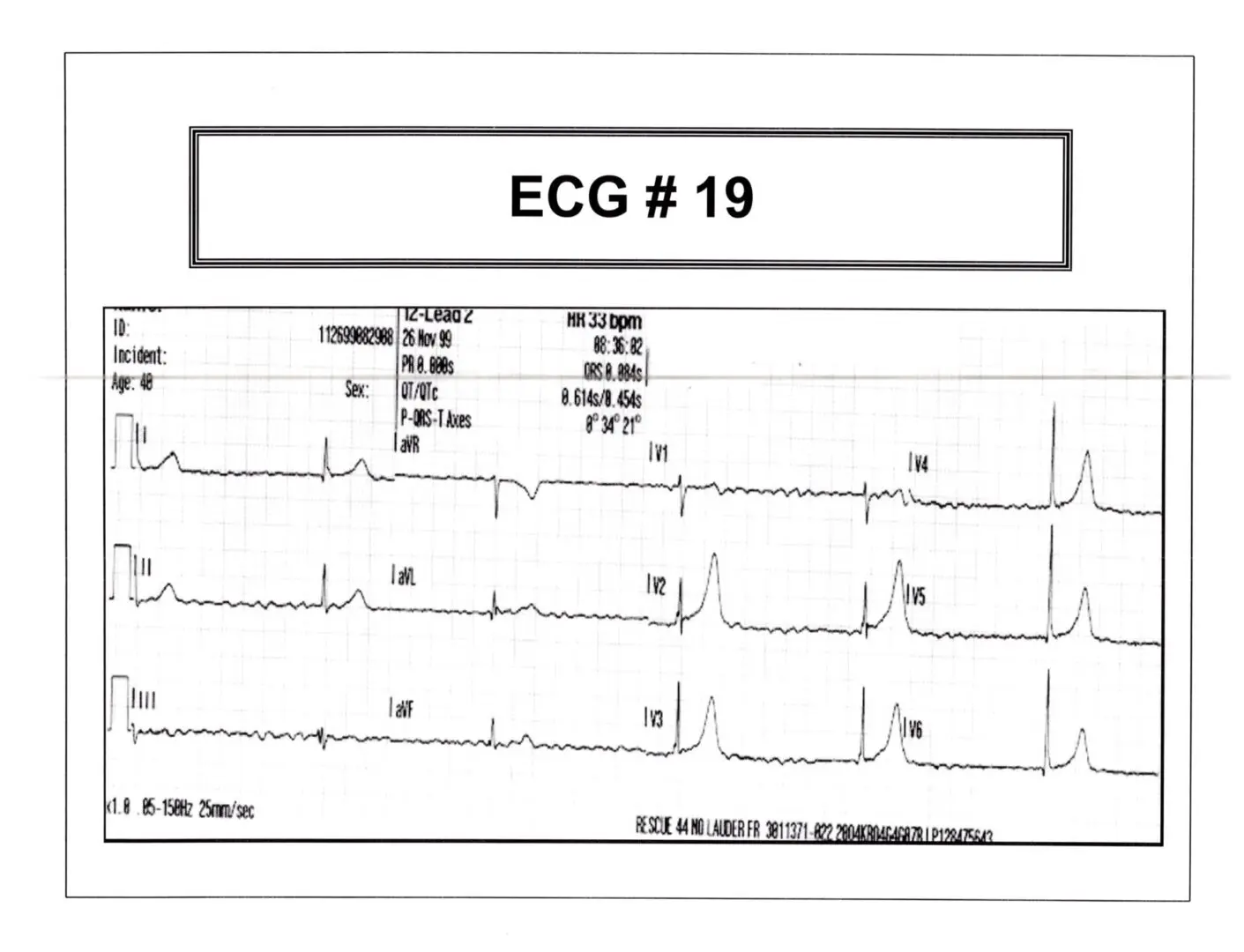 12 Lead ECG Basics: Interpretation and Application – Pro Med Ed